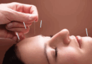 Acupuntura facial se torna tendência como alternativa natural ao botox